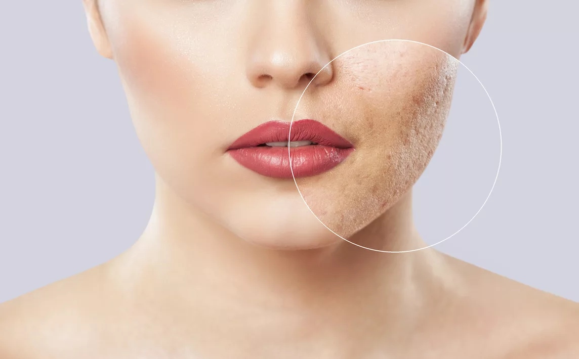 Pete rosii pe fata: Cauze, solutii, produse de skincare